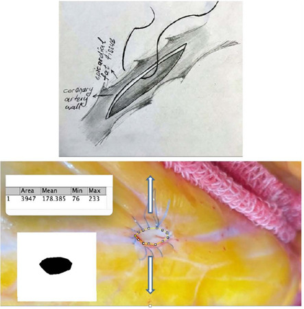Comparison of Two Coronary Anastomosis Techniques in Terms of Flow Rate in Porcine Hearts.