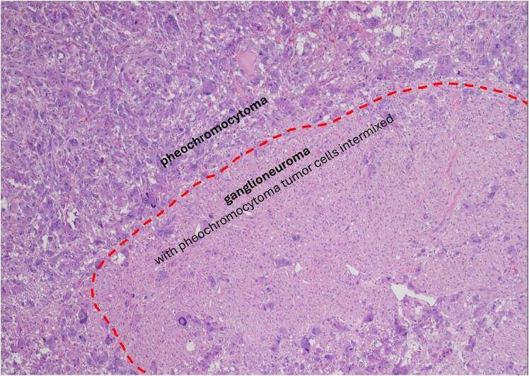 Composite Pheochromocytoma-Paraganglioma With Ganglioneuroma: A Dual-Center Clinical Experience.