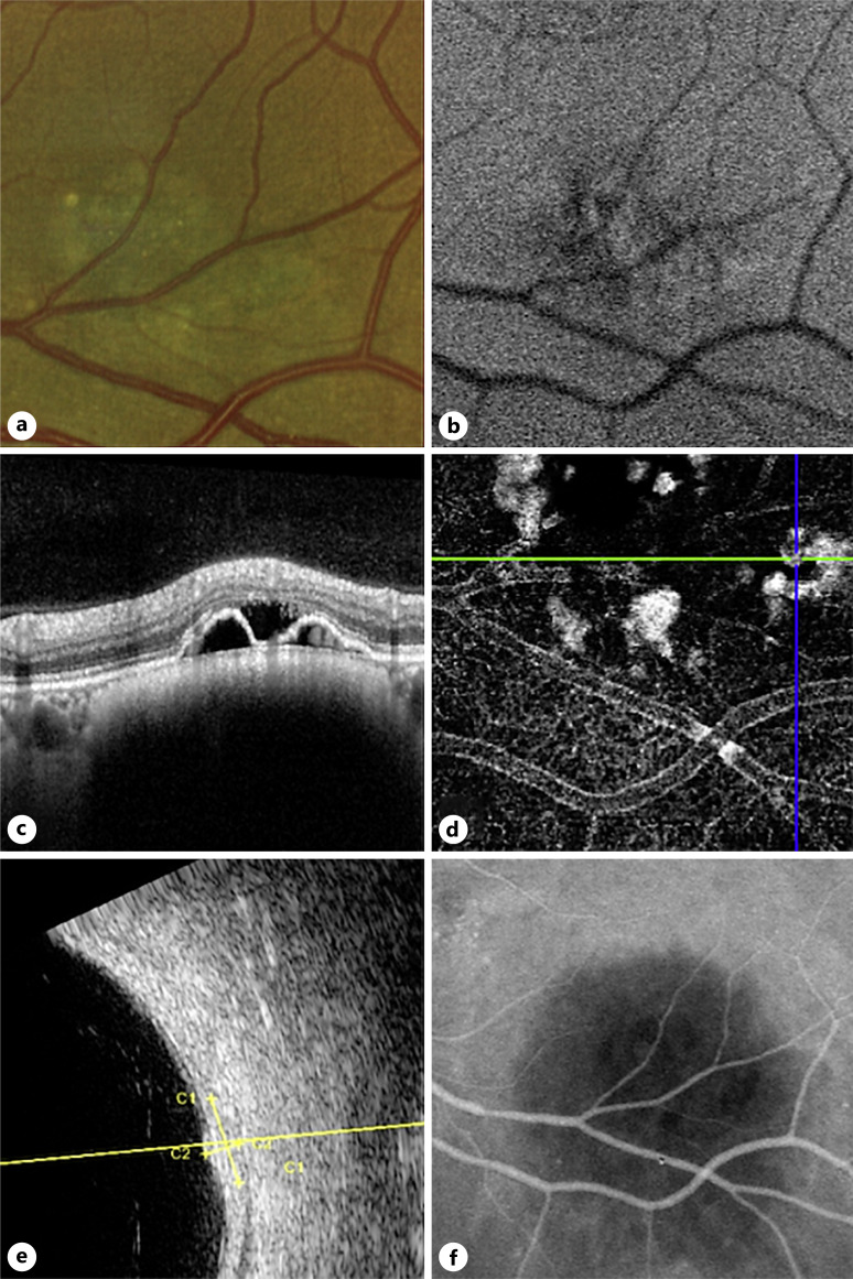 Six Cases of Polypoidal Choroidal Vasculopathy in Eyes with Choroidal Nevi.