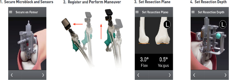 Caliper verification and gap measurements of kinematic alignment total knee arthroplasty utilizing an imageless, accelerometer-based navigation system.
