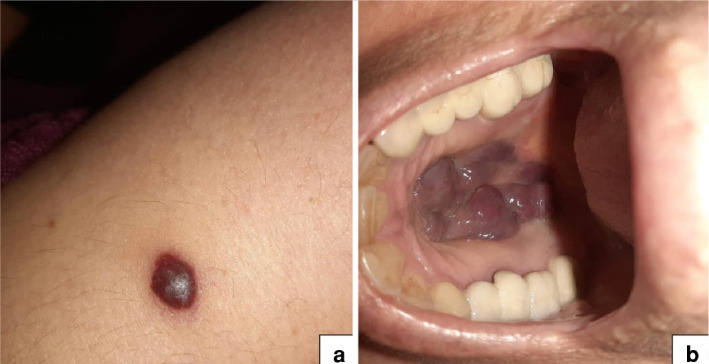 Kaposi's sarcoma developing in a geriatric patient with autoimmune hepatitis shortly after immunsupressive treatment.