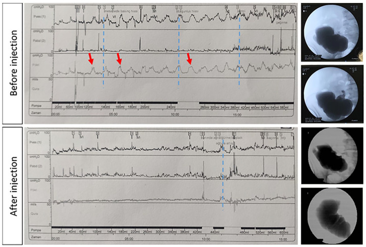 Endoscopic injection of botulinum toxin to prevent pouch contractions in a patient with Indiana pouch diversion.