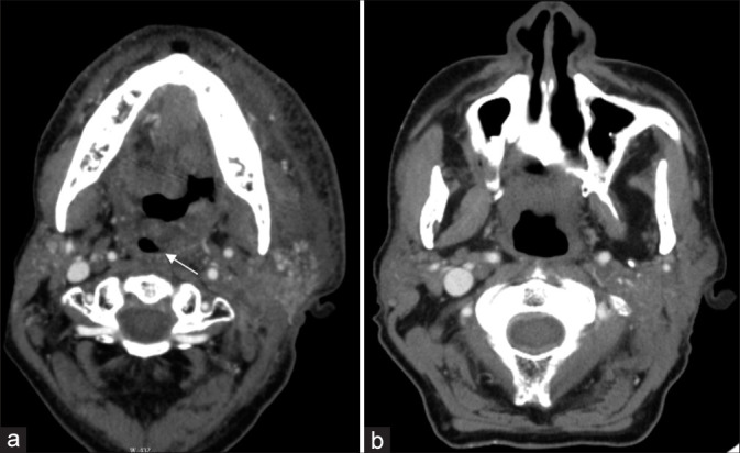 The imaging presentation of head and neck oncologic emergencies.
