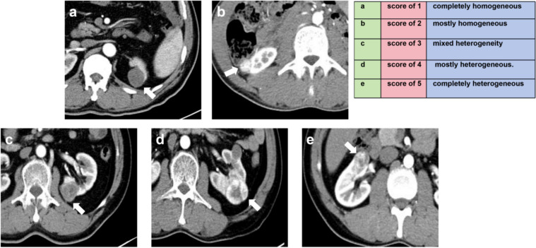 Development of modified multi-parametric CT algorithms for diagnosing clear-cell renal cell carcinoma in small solid renal masses.