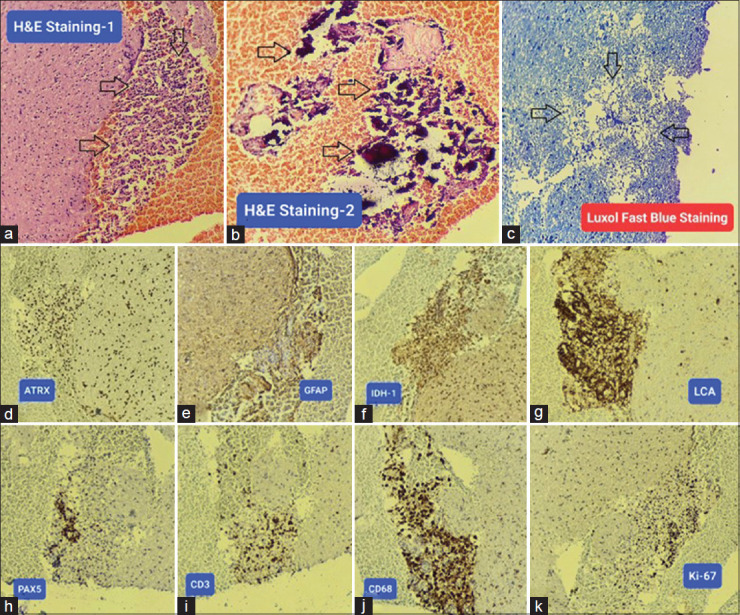 Treatment-resistant inflammatory demyelinating pseudotumor with Marburg-like features: A narrative review-based treatment approach.