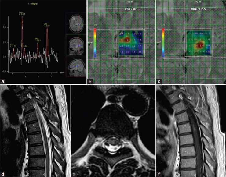 Treatment-resistant inflammatory demyelinating pseudotumor with Marburg-like features: A narrative review-based treatment approach.