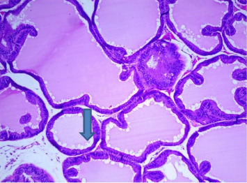 Assessing the Safety of Combined Therapy, <i>Croton membranaceus</i> and Tamsulosin, in the Self-Prescribed Treatment Protocol for Benign Prostatic Hyperplasia.