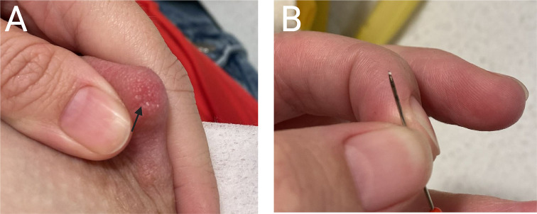 Recurrent Nipple Duct Obstruction in Two Breastfeeding Patients: A Case Report and Discussion of the Underlying Pathophysiology.