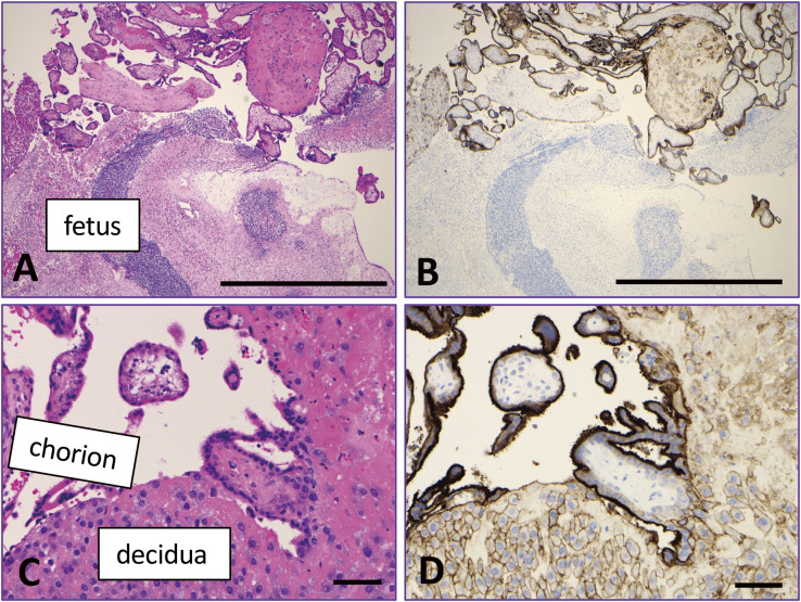 On the Similarity Between Postpartum Autoimmune Abnormalities and Immune-Related Adverse Events (irAE) by Immune Checkpoint Inhibitors (ICI): The Placenta as a PD-L1-Rich Immune-Tolerant Organ.