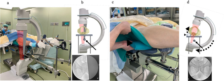Optimizing implant positioning in total hip arthroplasty via the direct anterior approach: The role and technique of conventional traction table and fluoroscopy.