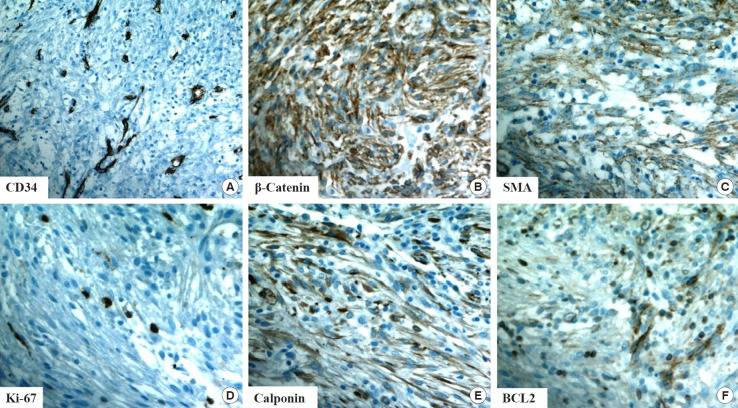 An inflammatory myofibroblastic tumor of the soft tissue of the neck: a case report and literature review.