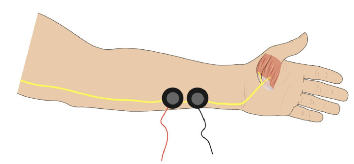 Current evidence on the use of sugammadex for neuromuscular blockade antagonism during electroconvulsive therapy: a narrative review.