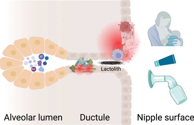 Recurrent Nipple Duct Obstruction in Two Breastfeeding Patients: A Case Report and Discussion of the Underlying Pathophysiology.