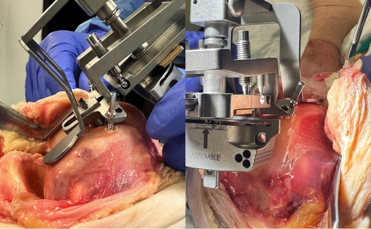 Caliper verification and gap measurements of kinematic alignment total knee arthroplasty utilizing an imageless, accelerometer-based navigation system.