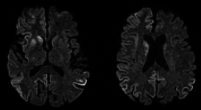 Creutzfeldt-Jakob disease mimicking limbic encephalitis as a cause of rapid neurological deterioration.