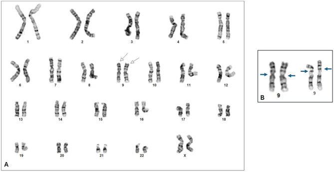 Whole genome uniparental isodisomy detected using single nucleotide polymorphism (SNP) microarray in molar pregnancy: a case report.
