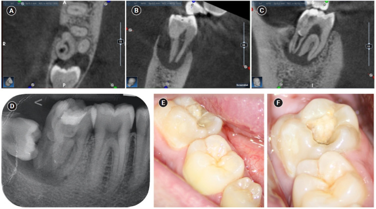 An unusual case of dens invaginatus on a mandibular second molar: a case report.