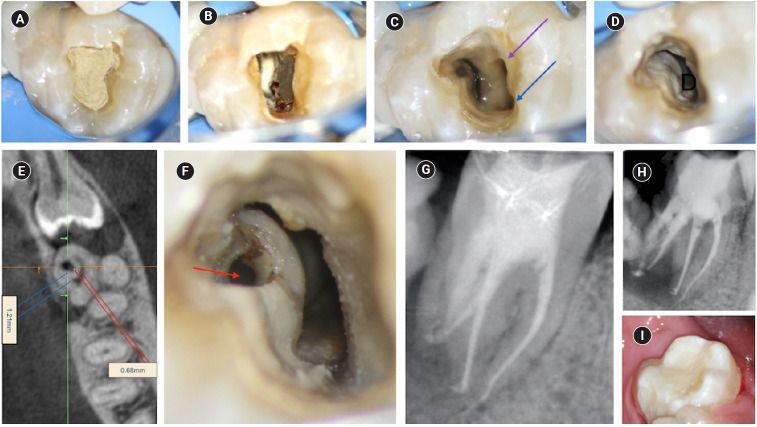 An unusual case of dens invaginatus on a mandibular second molar: a case report.