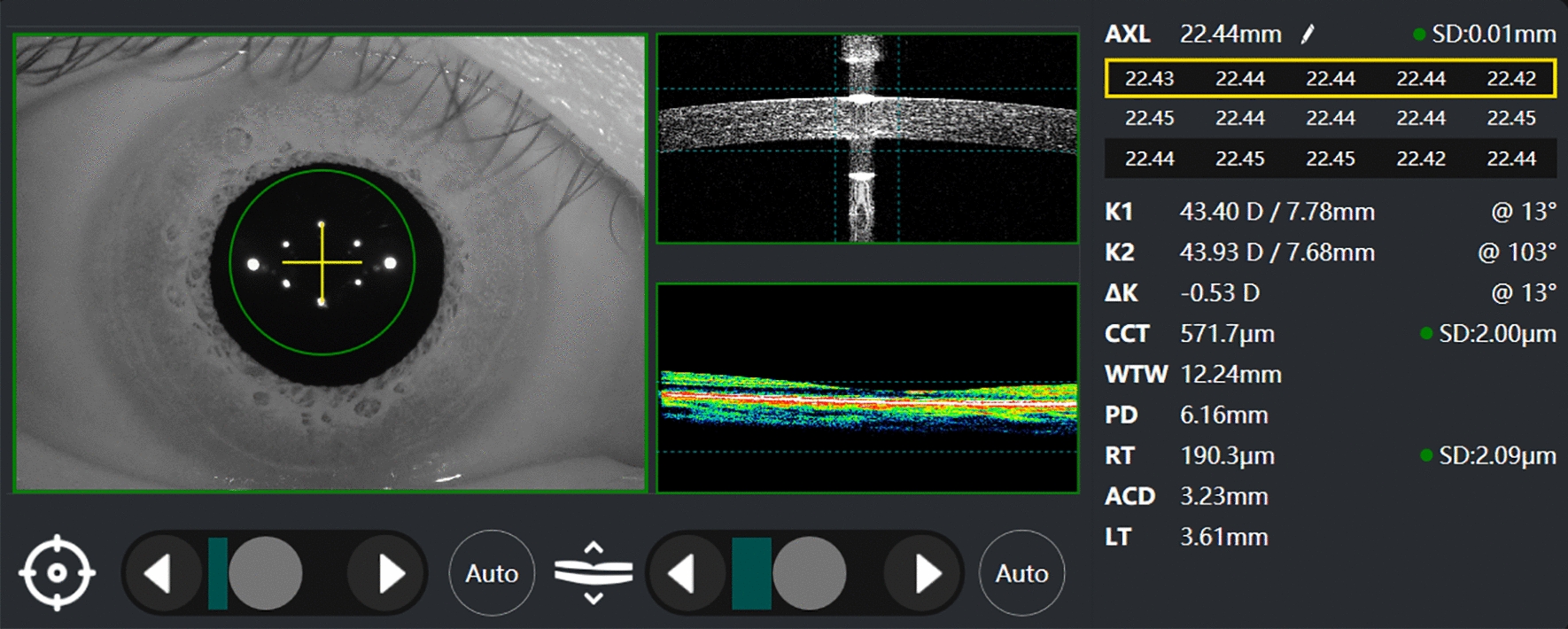 Repeatability and reproducibility of a new spectral-domain optical coherence tomography biometer and agreement with swept-source optical coherence tomography based biometer.