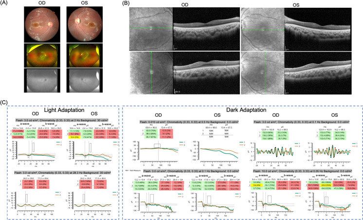 Novel CACNA1F pathogenic variant in pediatric incomplete X-linked CSNB: integrating portable ERG and genetic analysis.