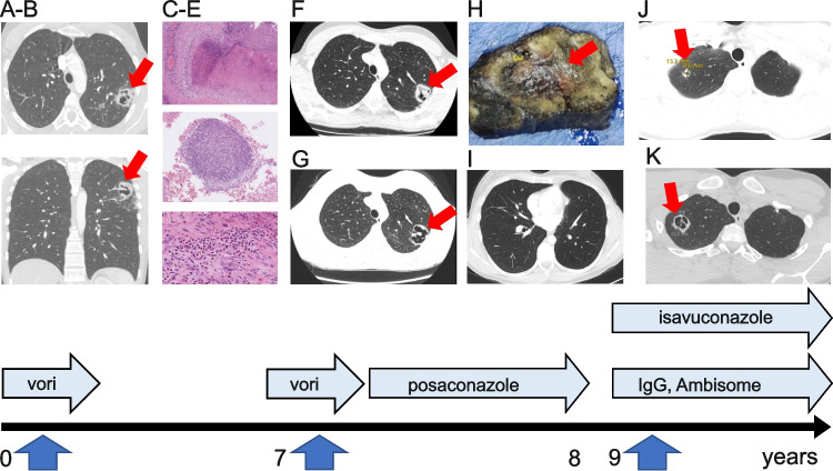 Pulmonary Aspergillosis and Low HIES Score in a Family with STAT3 N-Terminal Domain Mutation.