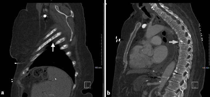 A Rare Case of Acute Aleukemic Mast Cell Leukemia With Osteoblastic Lesions in the Appendicular Skeleton.