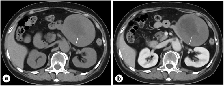 An Intra-Abdominal Desmoid Tumor with Edematous Loose Collagen Fibers.