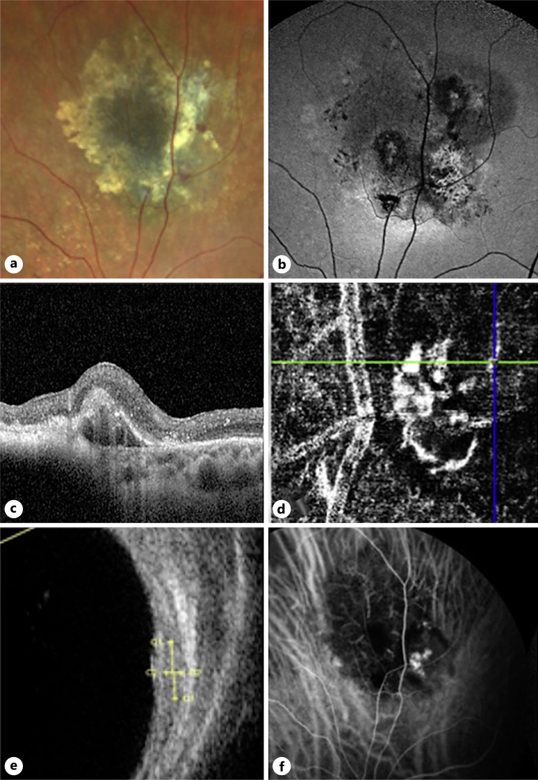 Six Cases of Polypoidal Choroidal Vasculopathy in Eyes with Choroidal Nevi.