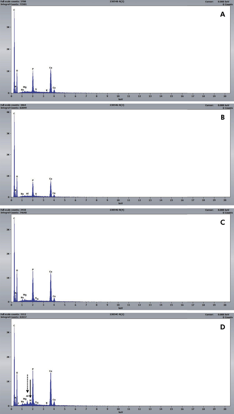 Occlusion, acid resistance, and elemental characterization of dentin treated with desensitizing agents.