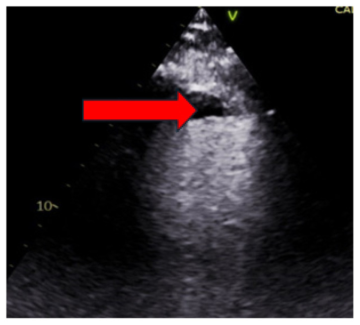 Working Backwards: Splenic Infarcts from Left Ventricular Thrombus.