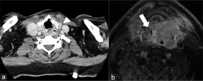 The imaging presentation of head and neck oncologic emergencies.