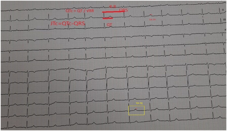 Impact of Different Metabolic Indicators on Ventricular Repolarization Indices in Obese Children: A Case Control Study.