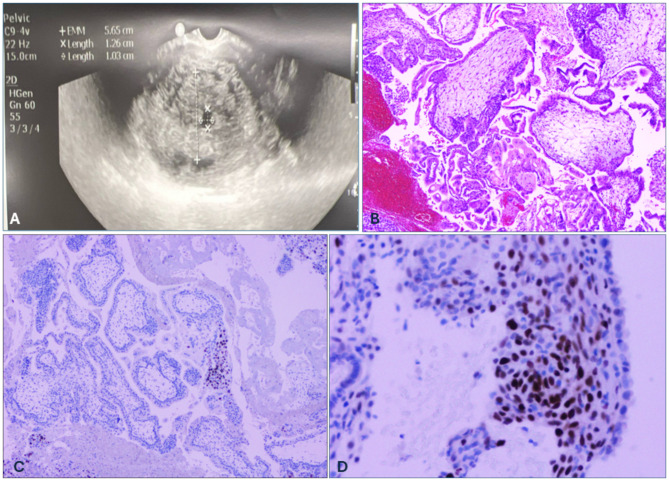 Whole genome uniparental isodisomy detected using single nucleotide polymorphism (SNP) microarray in molar pregnancy: a case report.