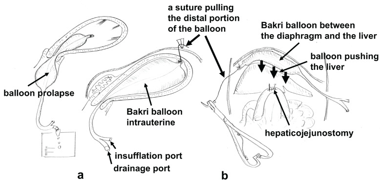 Letter to: The use of Bakri balloon to reduce the anastomosis tension in hepaticojejunostomy: An exchange between surgery and obstetrics/gynecology.