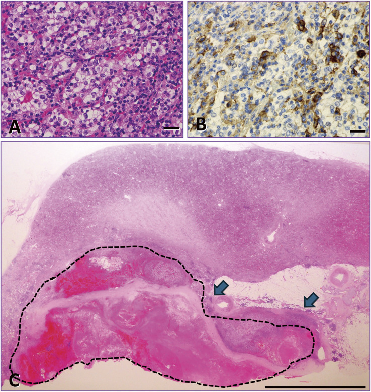 On the Similarity Between Postpartum Autoimmune Abnormalities and Immune-Related Adverse Events (irAE) by Immune Checkpoint Inhibitors (ICI): The Placenta as a PD-L1-Rich Immune-Tolerant Organ.