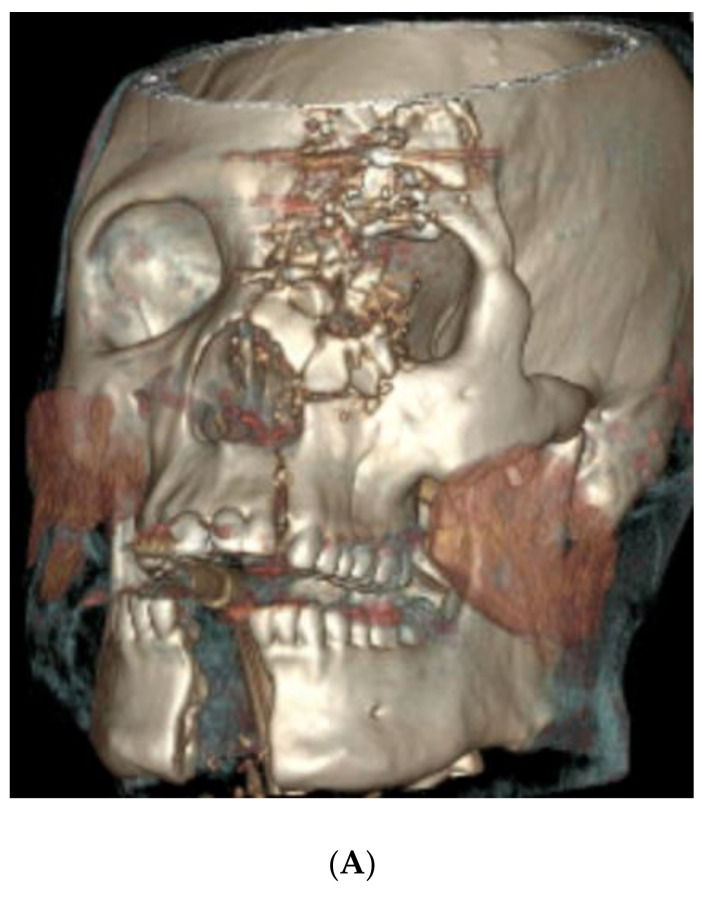 Virtual Surgical Planning for Management of Acute Maxillofacial Trauma.