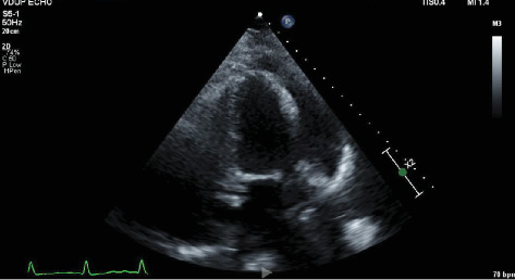 Hydralazine-Induced ANCA Vasculitis Presenting With Pericarditis: A Novel Case and Literature Review.