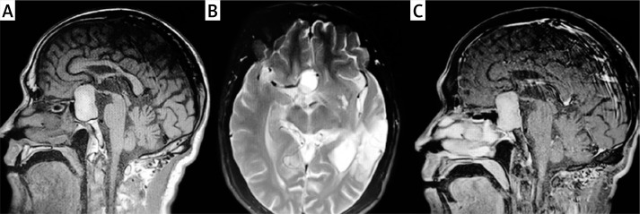 Effectiveness of endoscopic transnasal pituitary surgery versus antibiotic therapy in the management of pituitary abscess: a report of two cases.