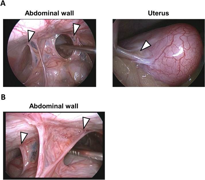 Development of a novel postoperative adhesion induction model in cynomolgus monkeys with high reliability and reproducibility.