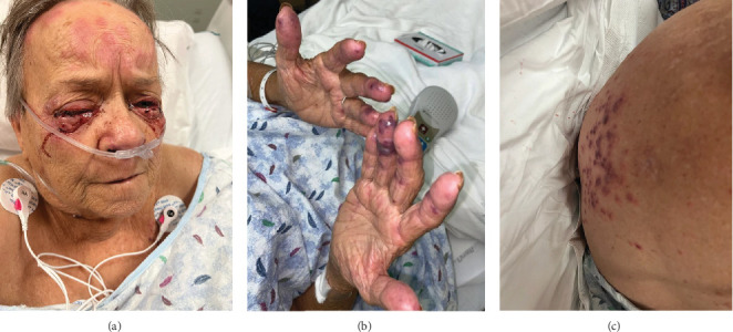 Hydralazine-Induced ANCA Vasculitis Presenting With Pericarditis: A Novel Case and Literature Review.