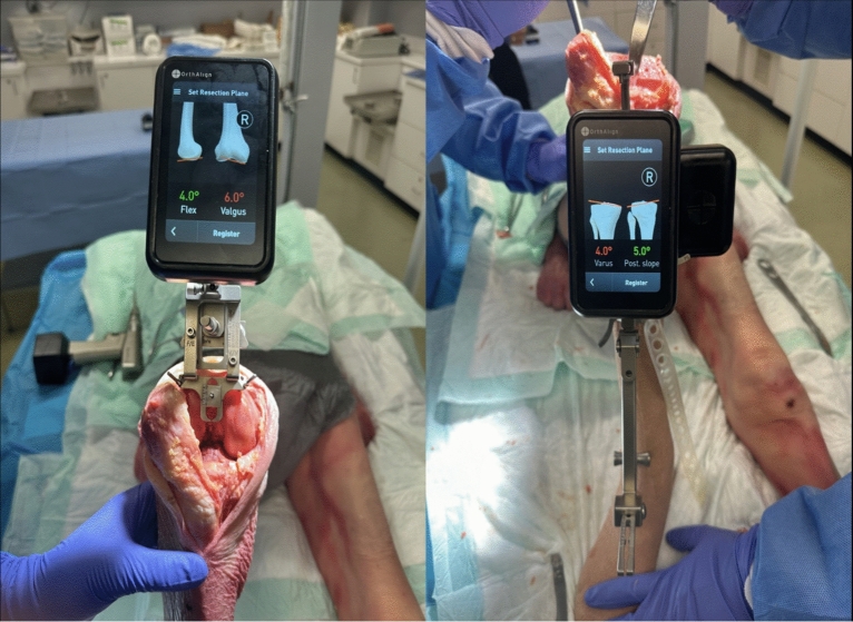 Caliper verification and gap measurements of kinematic alignment total knee arthroplasty utilizing an imageless, accelerometer-based navigation system.