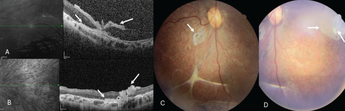 A Sandwich-Type Double-Layer Amniotic Membrane Graft for Repairing Myopic Macular Hole-Related Retinal Detachment in a Child with Knobloch Syndrome.