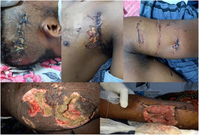 Deadly Injuries Sustained From a Hyena Attack: The Importance of Timely Diagnosis and Treatment - A Case Report.