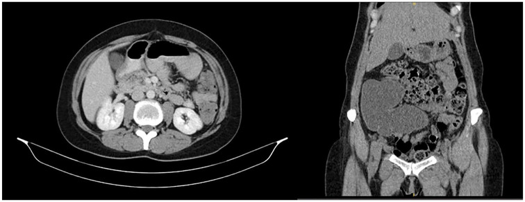 Endoscopic injection of botulinum toxin to prevent pouch contractions in a patient with Indiana pouch diversion.