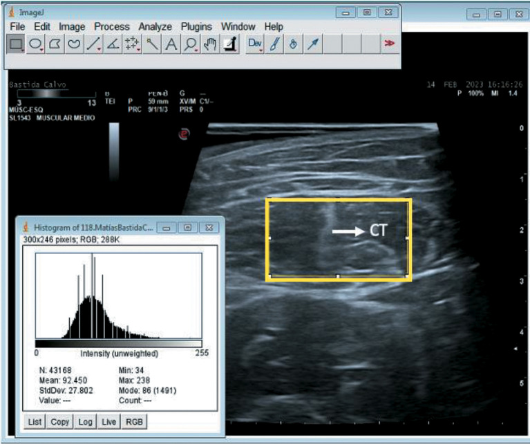 Association between muscle strength and echogenicity using greyscale ultrasound software: a diagnostic accuracy study in kidney transplant candidates.