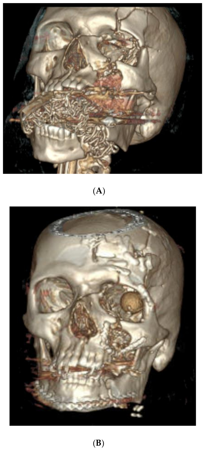 Virtual Surgical Planning for Management of Acute Maxillofacial Trauma.