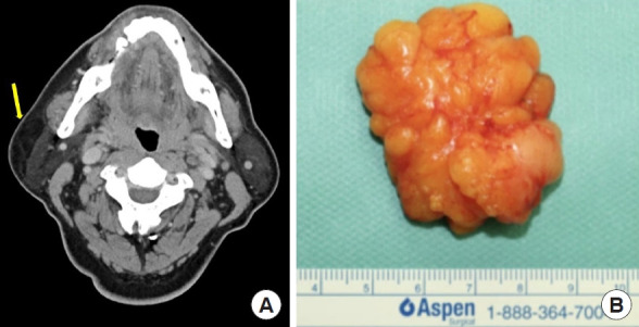 The diagnostic accuracy of depth prediction for lipomas by preoperative imaging with distribution according to anatomical site in Korea: a retrospective analysis.