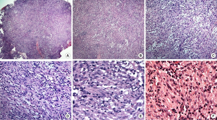 An inflammatory myofibroblastic tumor of the soft tissue of the neck: a case report and literature review.