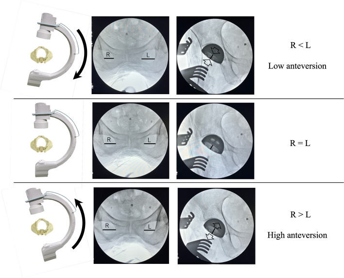 Optimizing implant positioning in total hip arthroplasty via the direct anterior approach: The role and technique of conventional traction table and fluoroscopy.