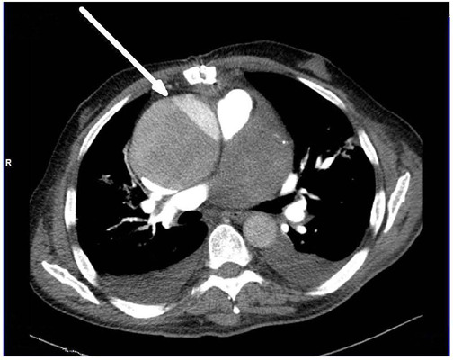 Early Acute Aortic Dissection After Coronary Artery Bypass Grafting.